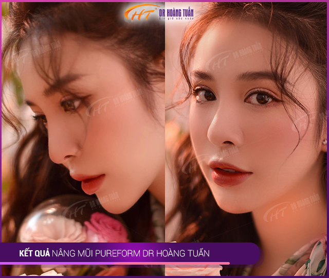 Kết quả nâng mũi Pureform tại Thẩm mỹ Hoàng Tuấn